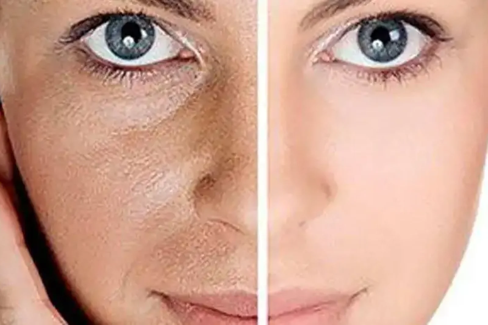 Microneedling copy