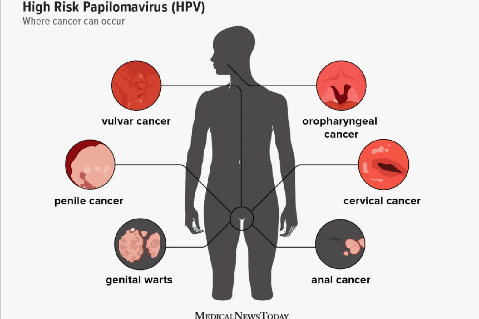 hpv-symptoms-1296x1000-body-1024x793 copy